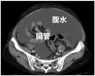 大量の腹水貯留のCT像（骨盤部のスライス）